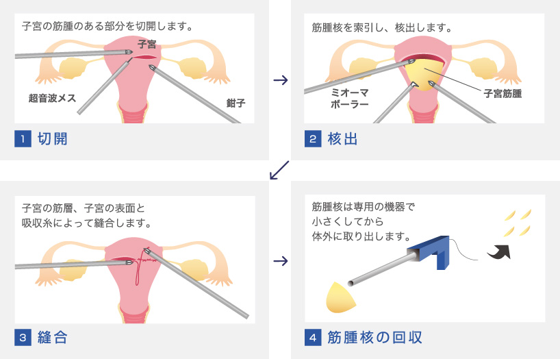 センチ 子宮 筋腫 3 知って得する病気の話_子宮筋腫のおはなし（産婦人科）