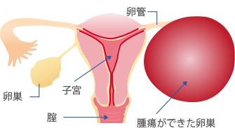 腫瘍 手術 卵巣 卵巣腫瘍(症状や要因、合併症、治療法など)