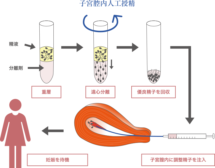 子宮腔内人工授精