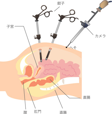 腹腔鏡手術画像