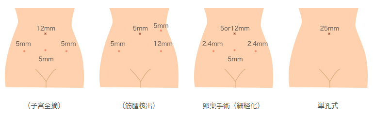 腹腔鏡手術画像