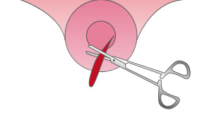 子宮 頚 管 ポリープ